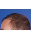 After Hair Transplant&nbsp;Front